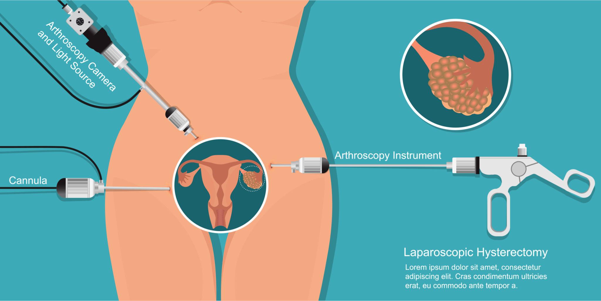 Hysteroscopic Myomectomy in Pune – Safe & Scarless Fibroid Removal